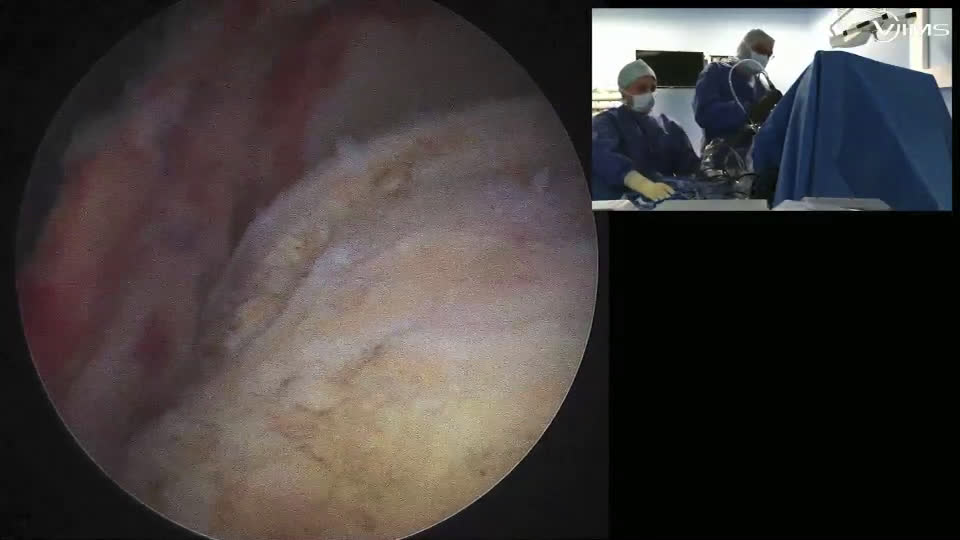 Réparation partielle de coiffe + superior capsular reconstruction au long biceps (Dr Audebert)