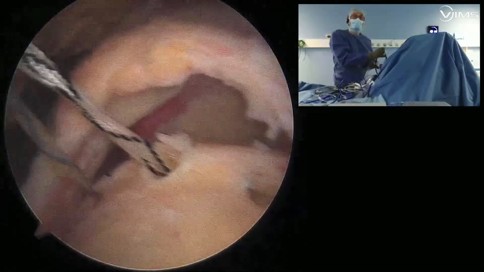 Coiffe massive postéro-supérieure (Dr Audebert)