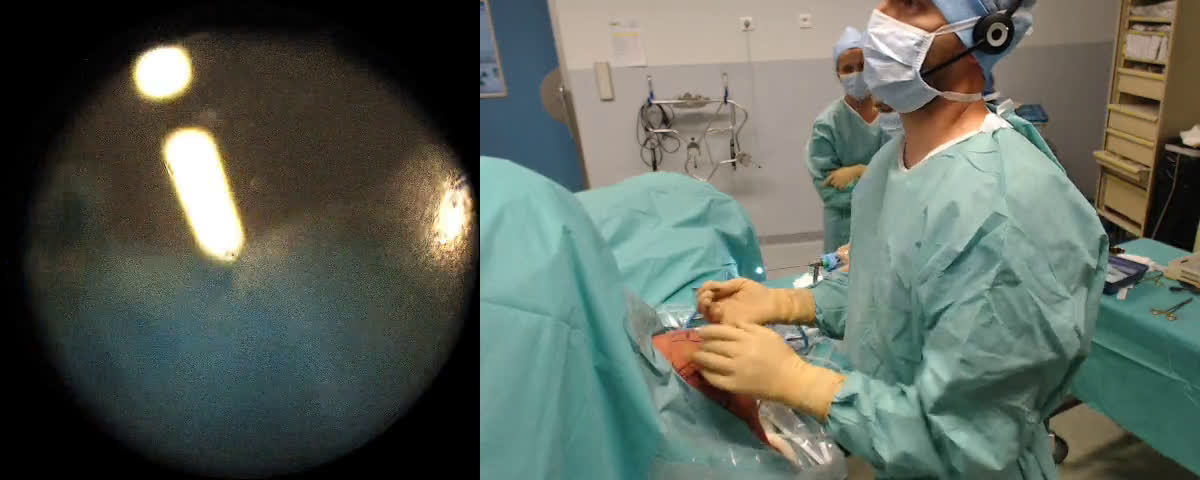 Double endo-bouton sur Disjonction Acromio-Claviculaire ( Croutzet)