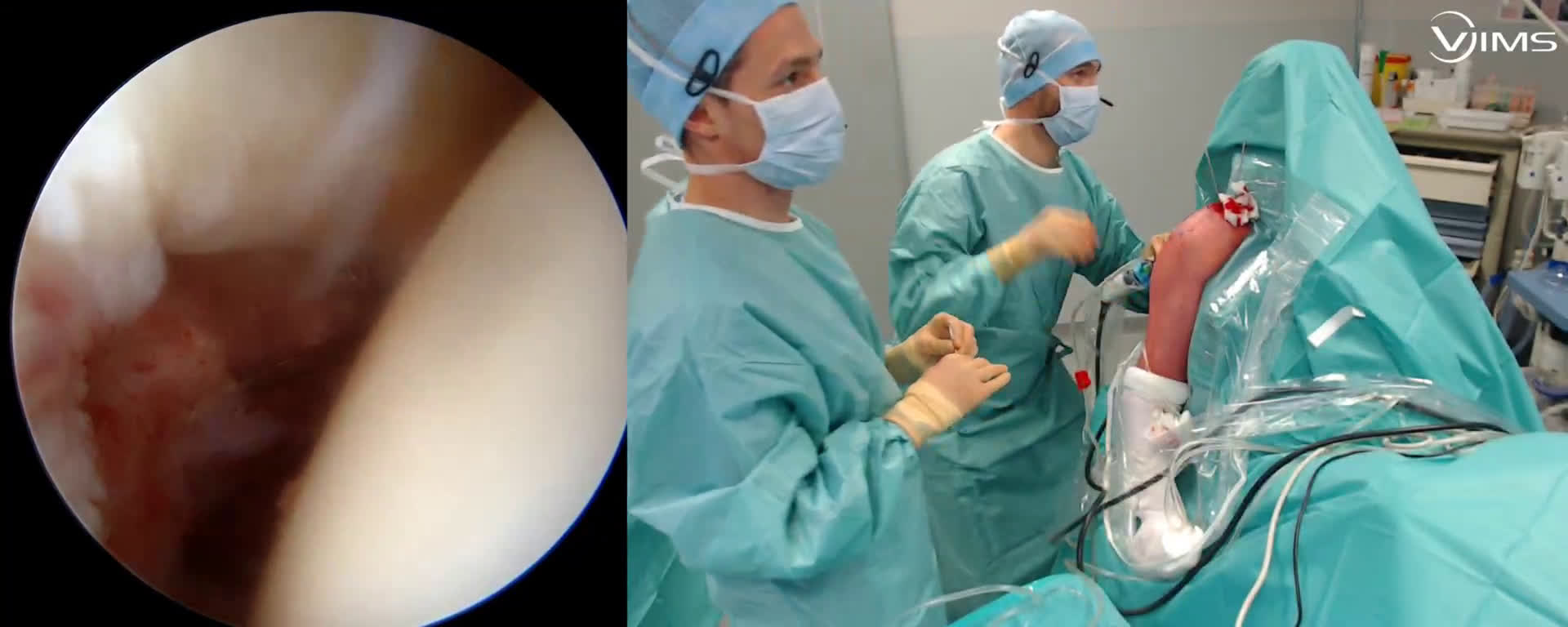 Disjonction acromio claviculaire avec double endo-bouton VIMS sous arthroscopie ( Croutzet)