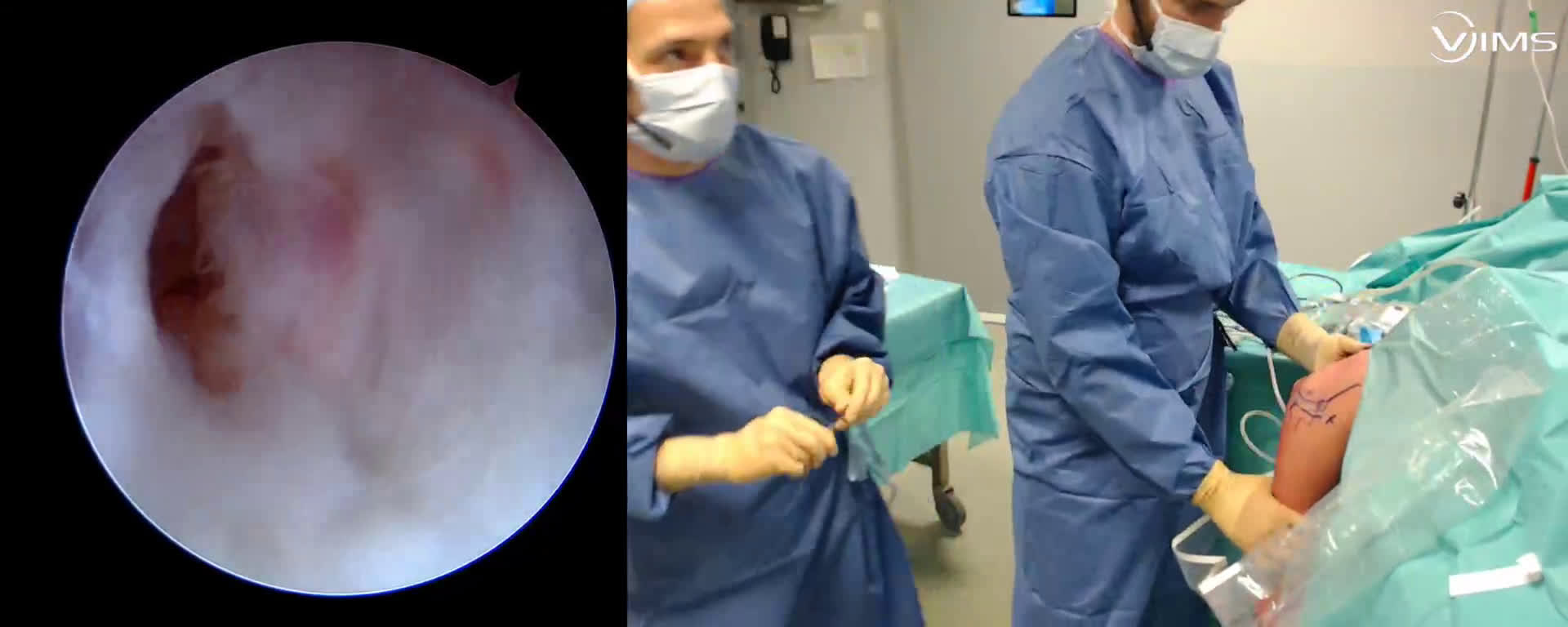 Arthrolyse du coude droit sous arthroscopie ( Croutzet)
