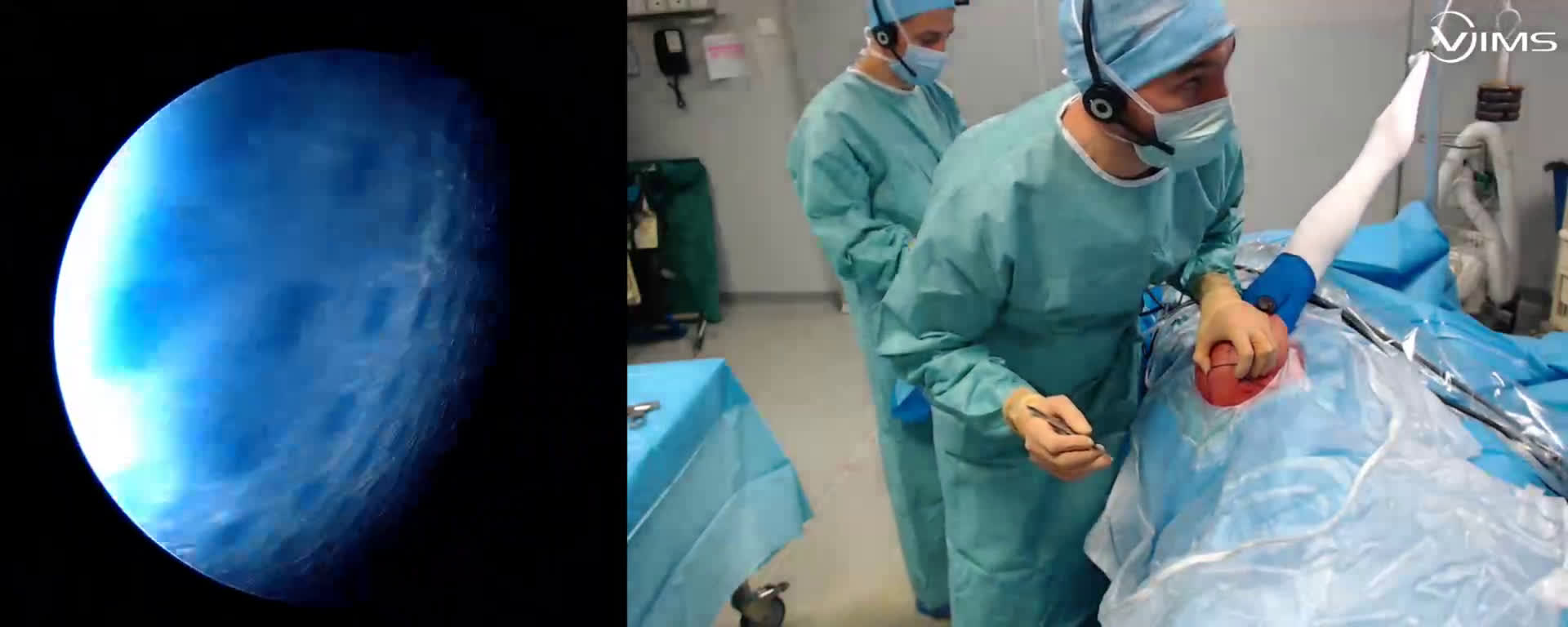 Réparation de la coiffe sub-scapulaire avec le Soft Anchor VIMS ( Croutzet)