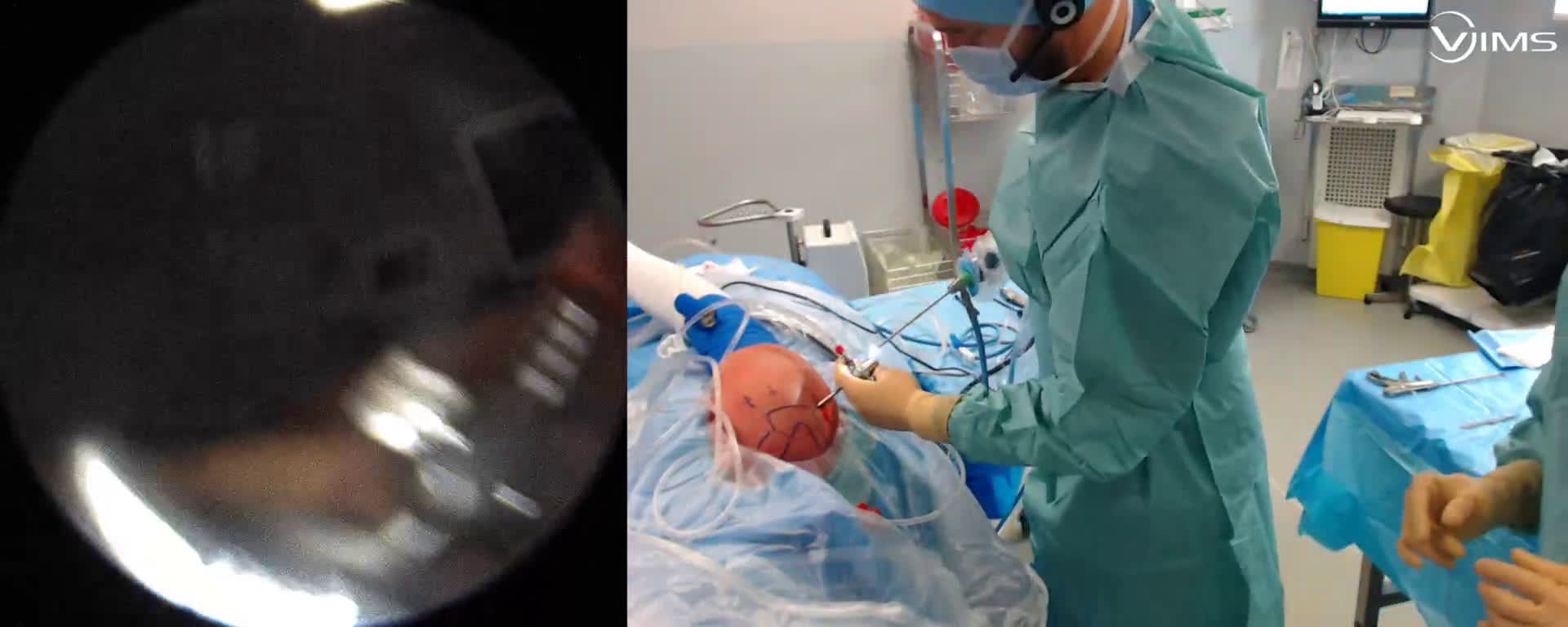 Révision de coiffe suite à une rupture traumatique sous arthroscopie ( Croutzet)