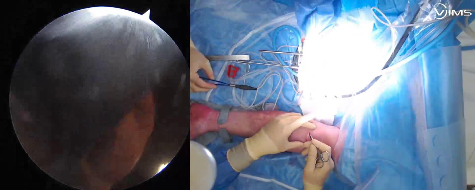 Réinsertion du biceps distal avec contrôle arthroscopique ( Croutzet)