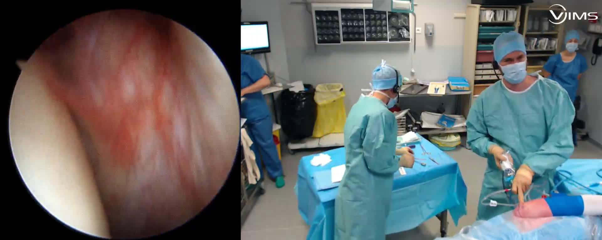 Petite lésion de coiffe sous arthroscopie ( Croutzet)