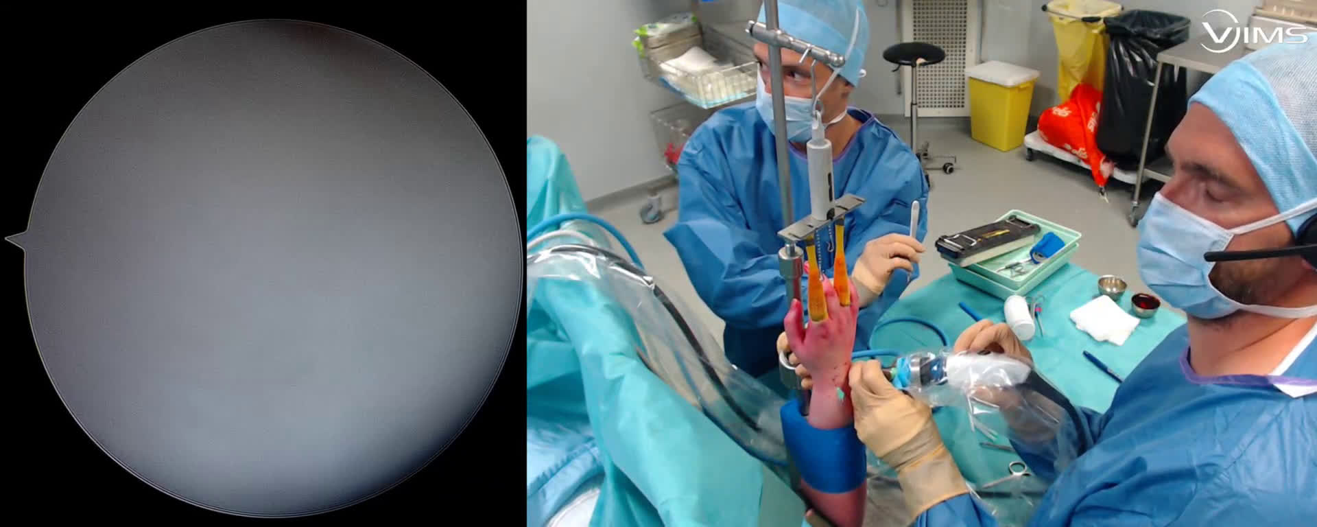 Kyste du poignet dorsal et palmaire sous arthroscopie ( Croutzet)