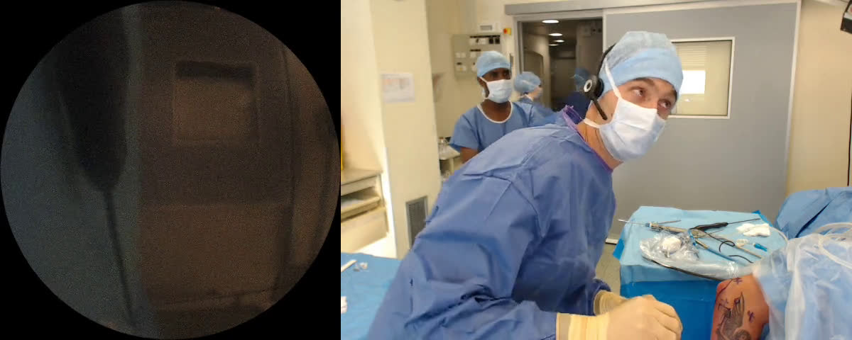 Arthrolyse du coude antérieure et postérieure ( Croutzet)