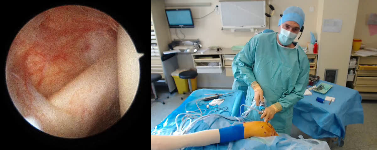 Libération du nerf supra-scapulaire à l'échancrure coracoïdienne. ( Croutzet)
