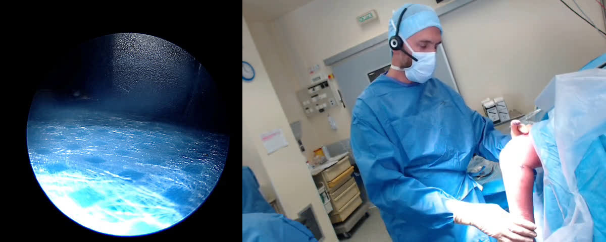 Fracture de tête radiale sous arthroscopie ( Croutzet)