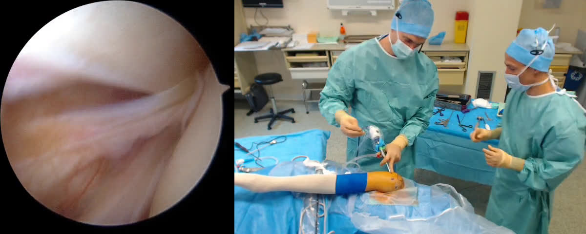Deep tear of the supra-spinatus tendon ( Croutzet)