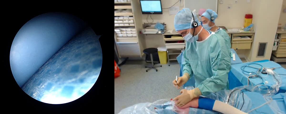 Acromioplastie et ténodèse biceps épaule ( Croutzet)