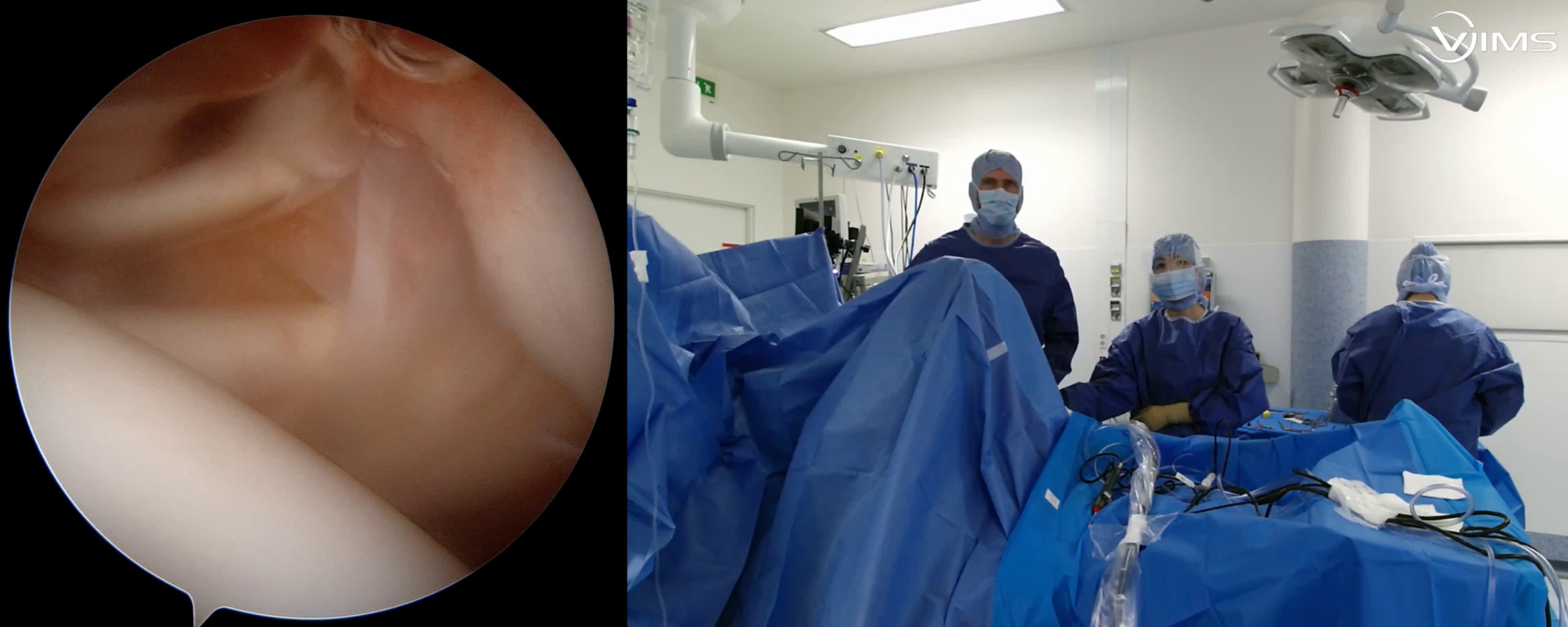 Bankart posterieur sous arthroscopie (Dr Godeneche)