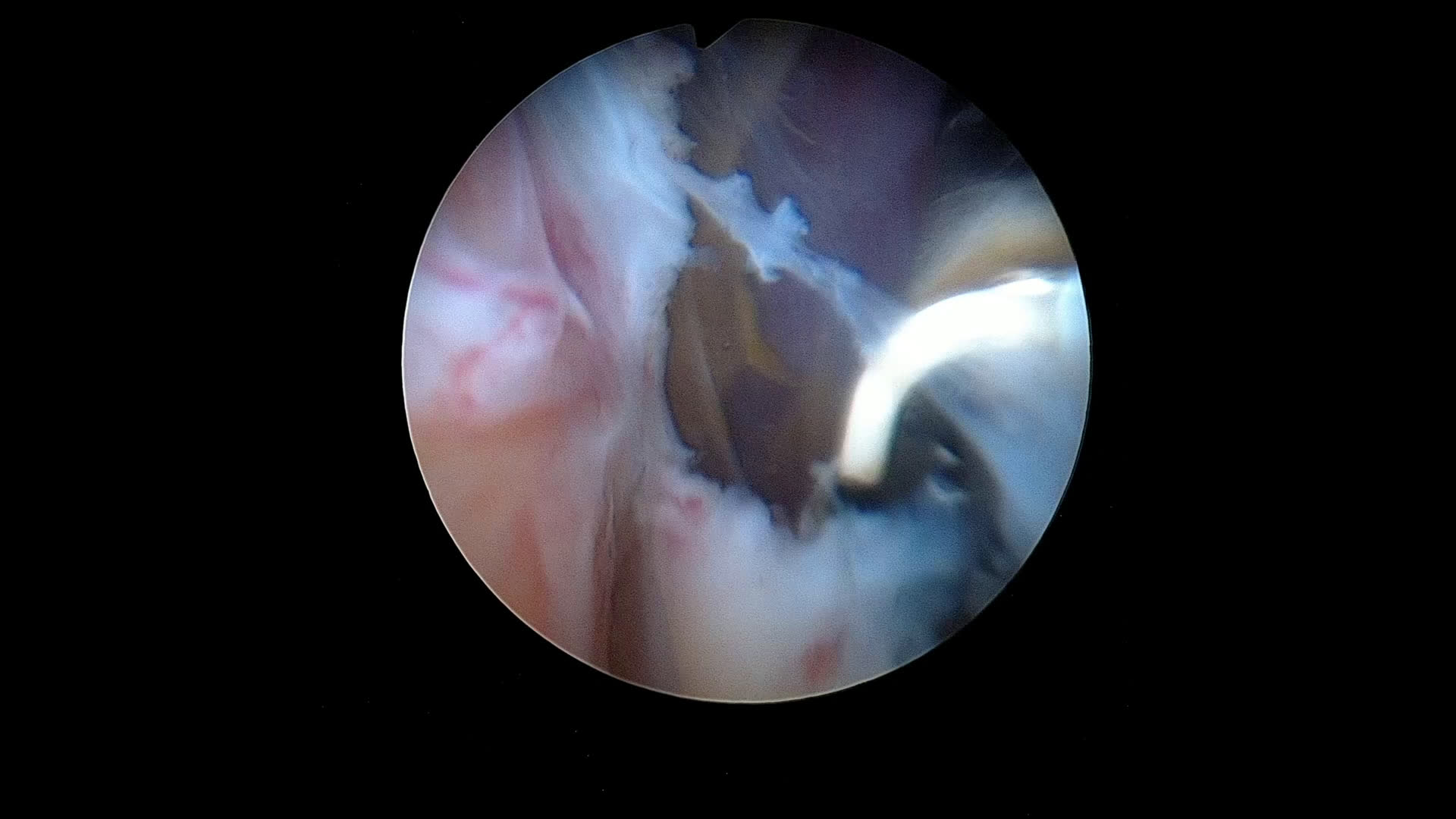 Panorama view et acromioplastie commentée A (Dr Godeneche)
