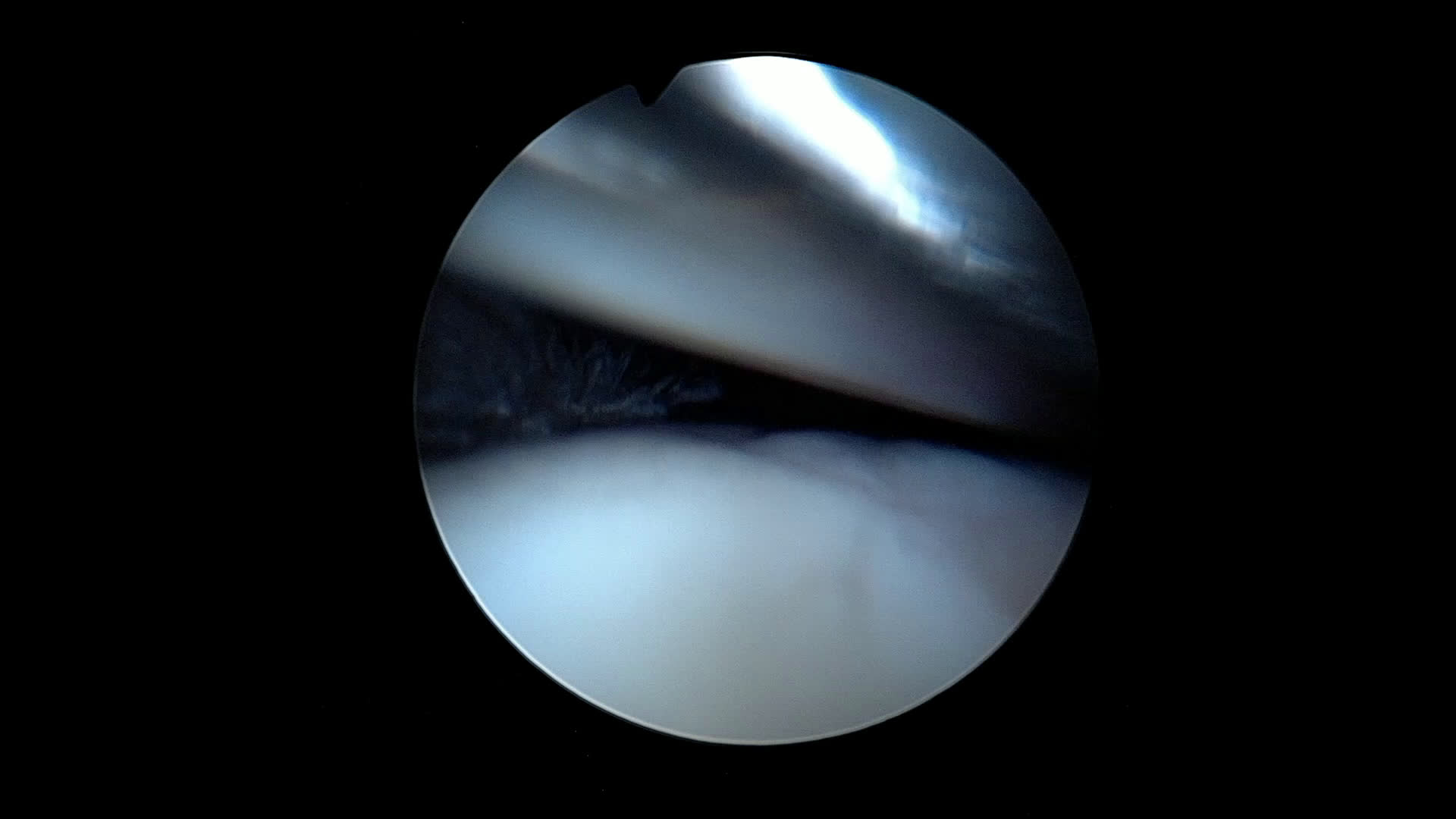 Rupture massive antéro-supérieure (Dr Godeneche)