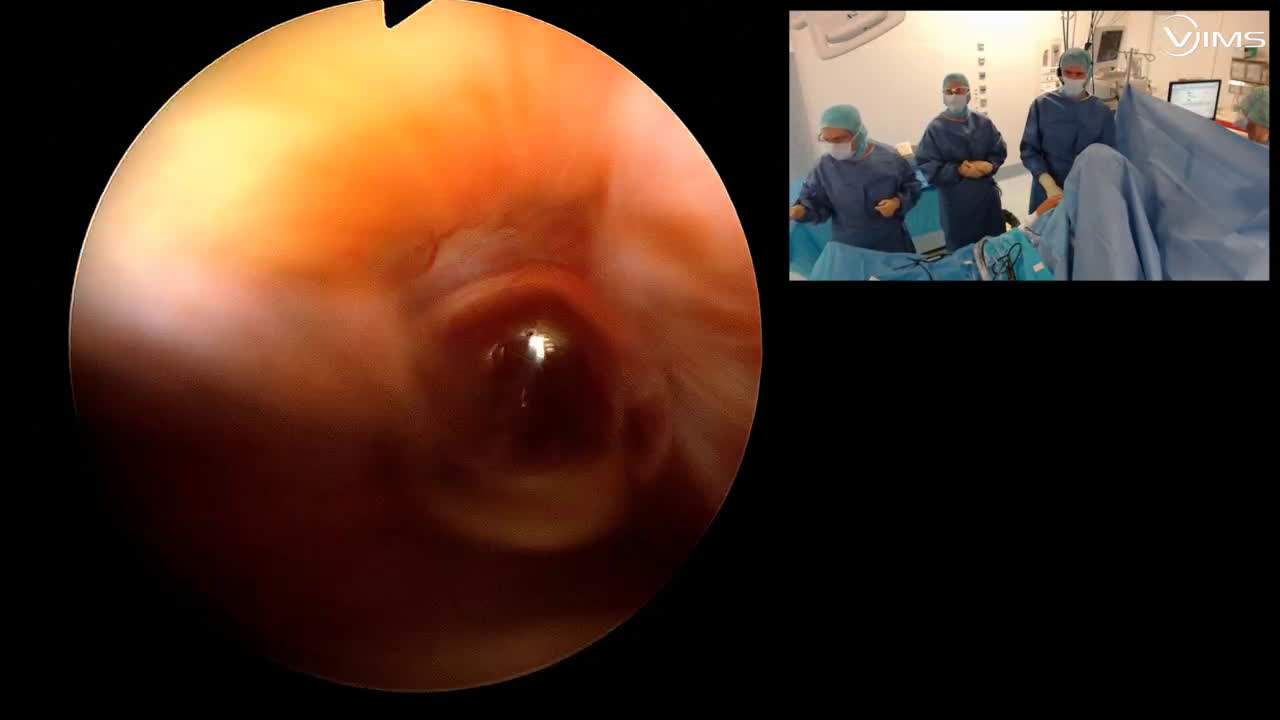 Lésion difficle face superficielle coiffe postéro-supérieure (Dr Godeneche)