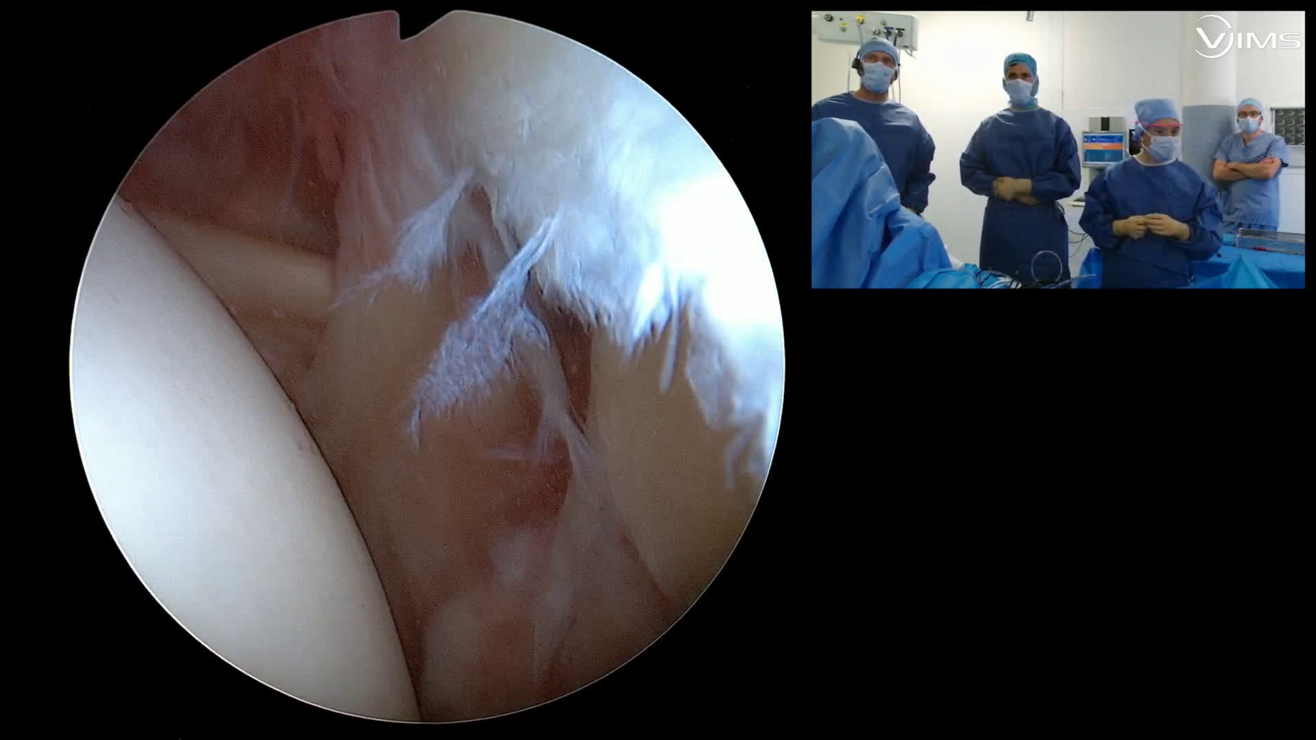 Neurolyse arthroscopique du nerf supra scapulaire. (Dr Godeneche)