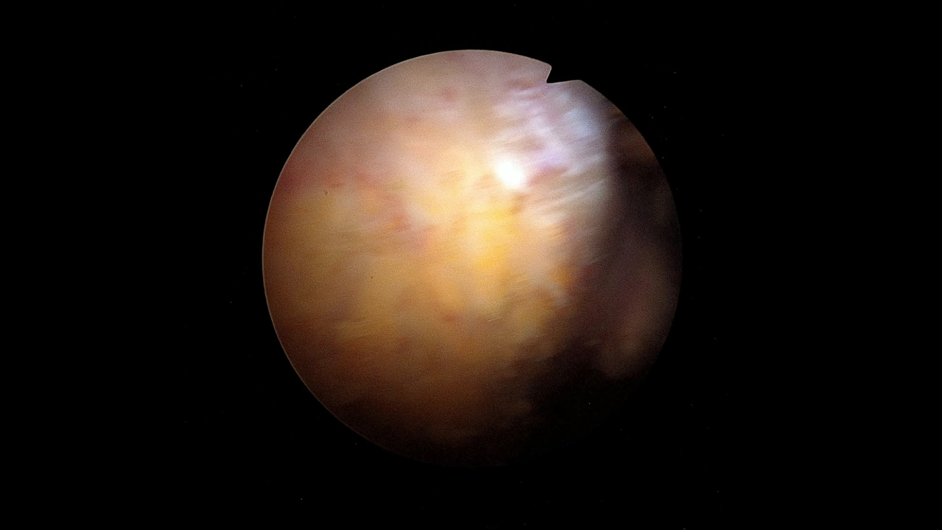 Tendinopathie calcifiante mutiples types B (sscap) (Dr Godeneche)