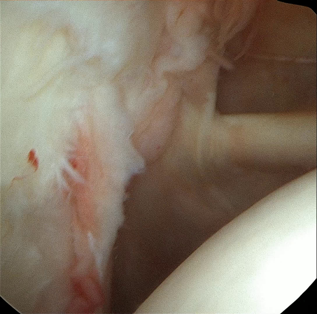Lésions instabilité bipolaire (Dr Godeneche)