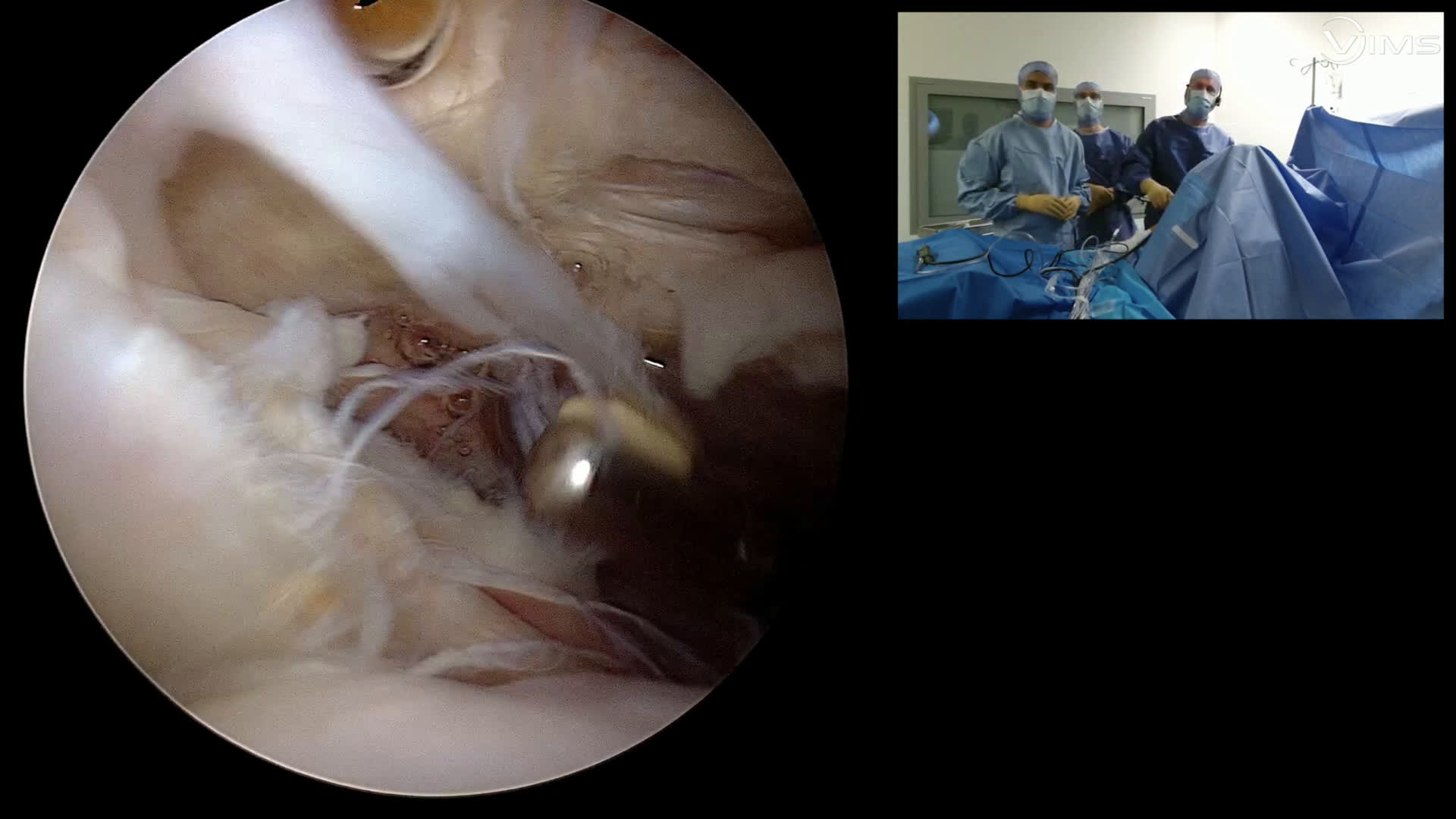 Coiffe massive - reconstruction capsulaire au long biceps (Dr Godeneche)
