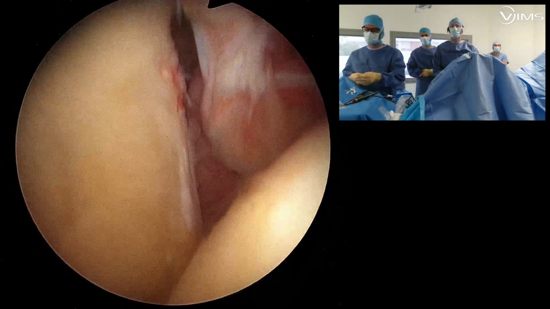 Dégantage coiffe (Dr Godeneche)