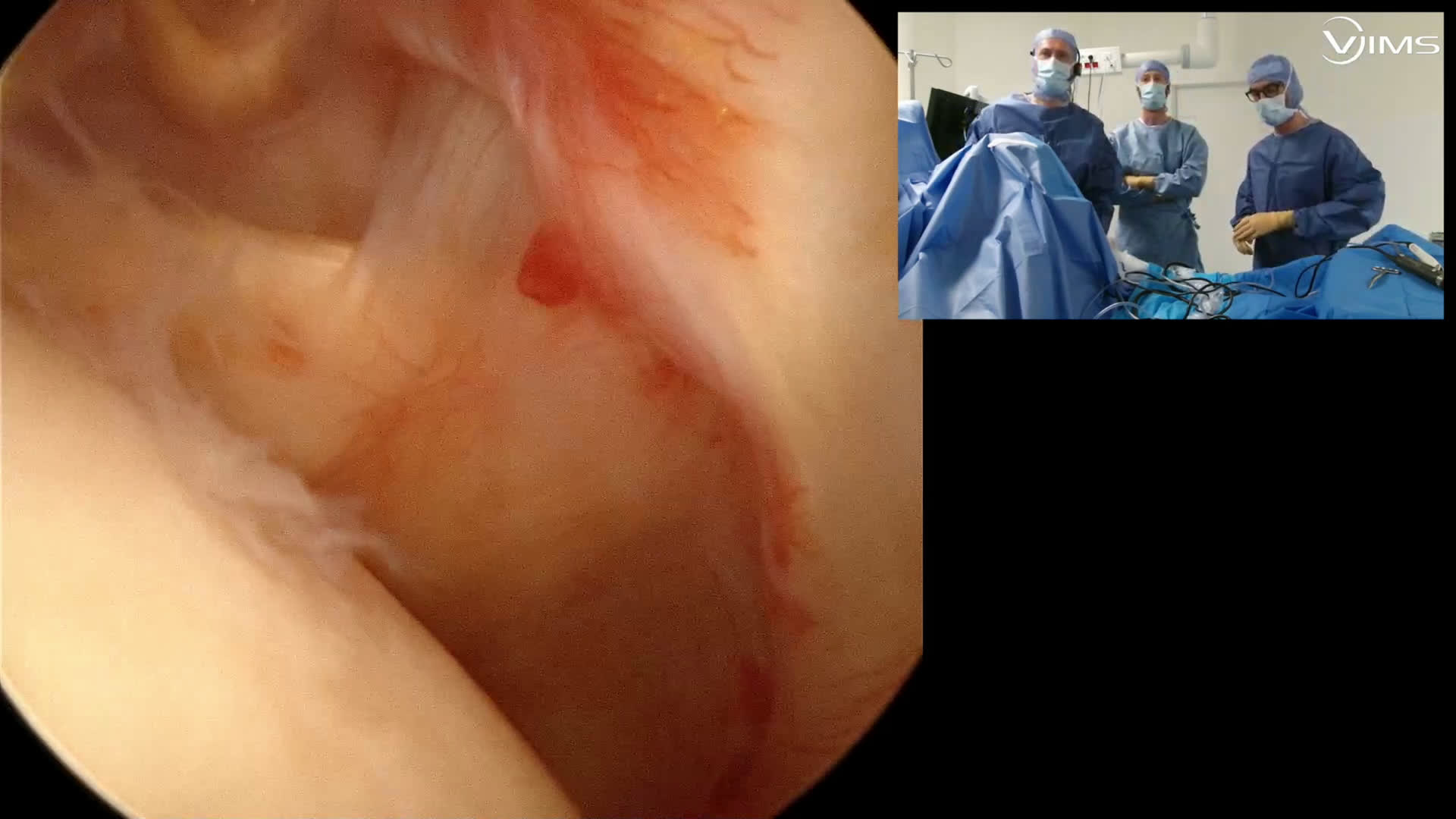 Réparation rupture face superficielle supra-épineux (Dr Godeneche)
