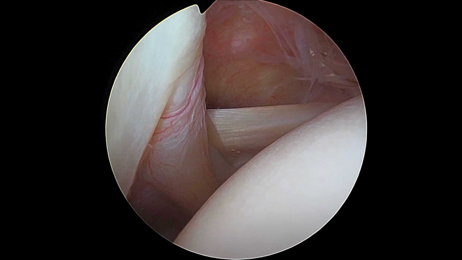 Rupture partielle face superficielle 1 (Dr Godeneche)