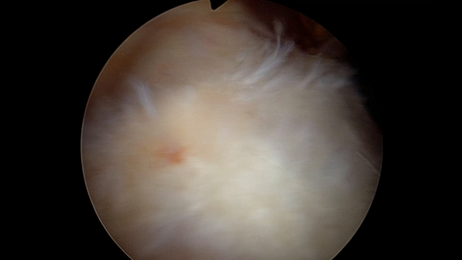 Réparation coiffe face superficielle (1/3) (Dr Godeneche)