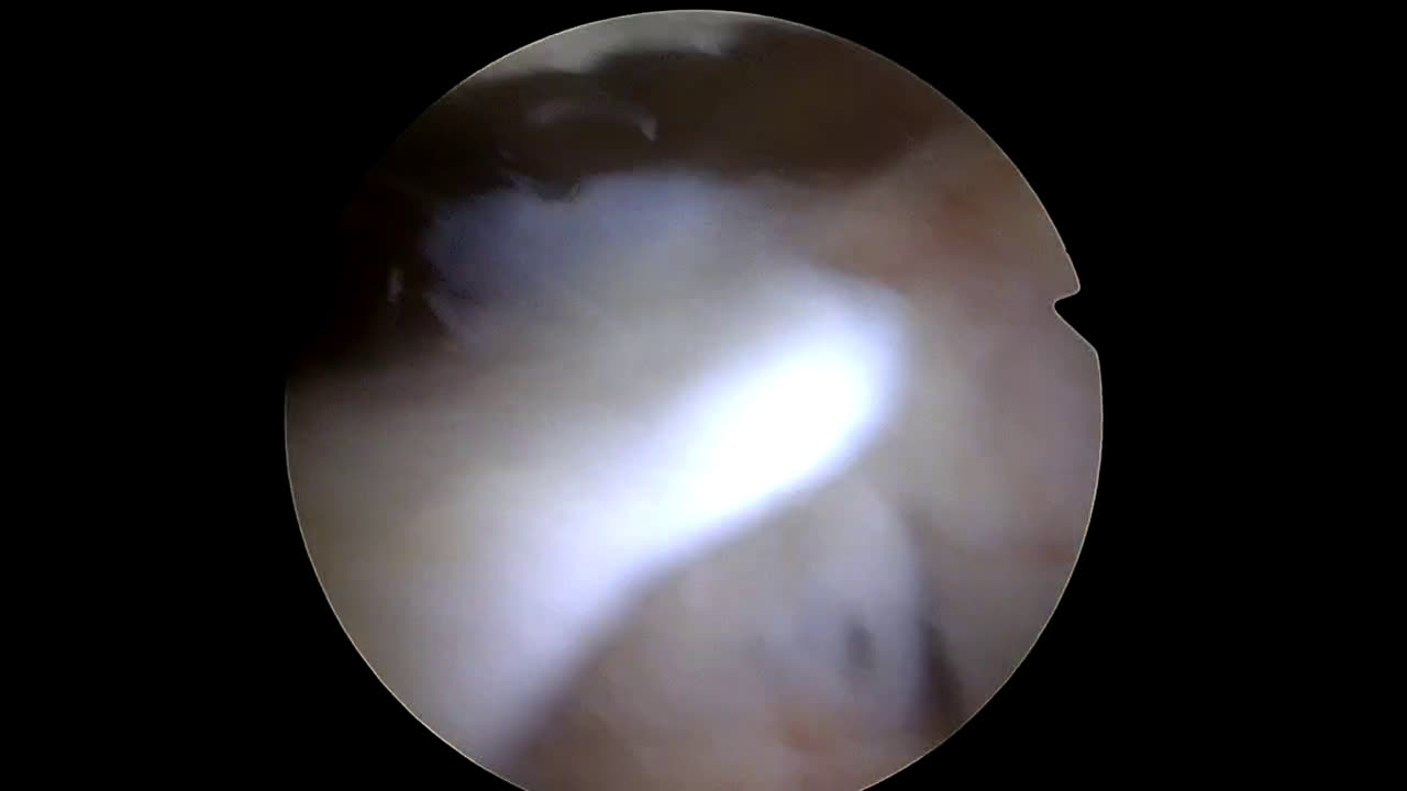 Exploration d'un `flip` du tendon supra-épineux (Dr Godeneche)