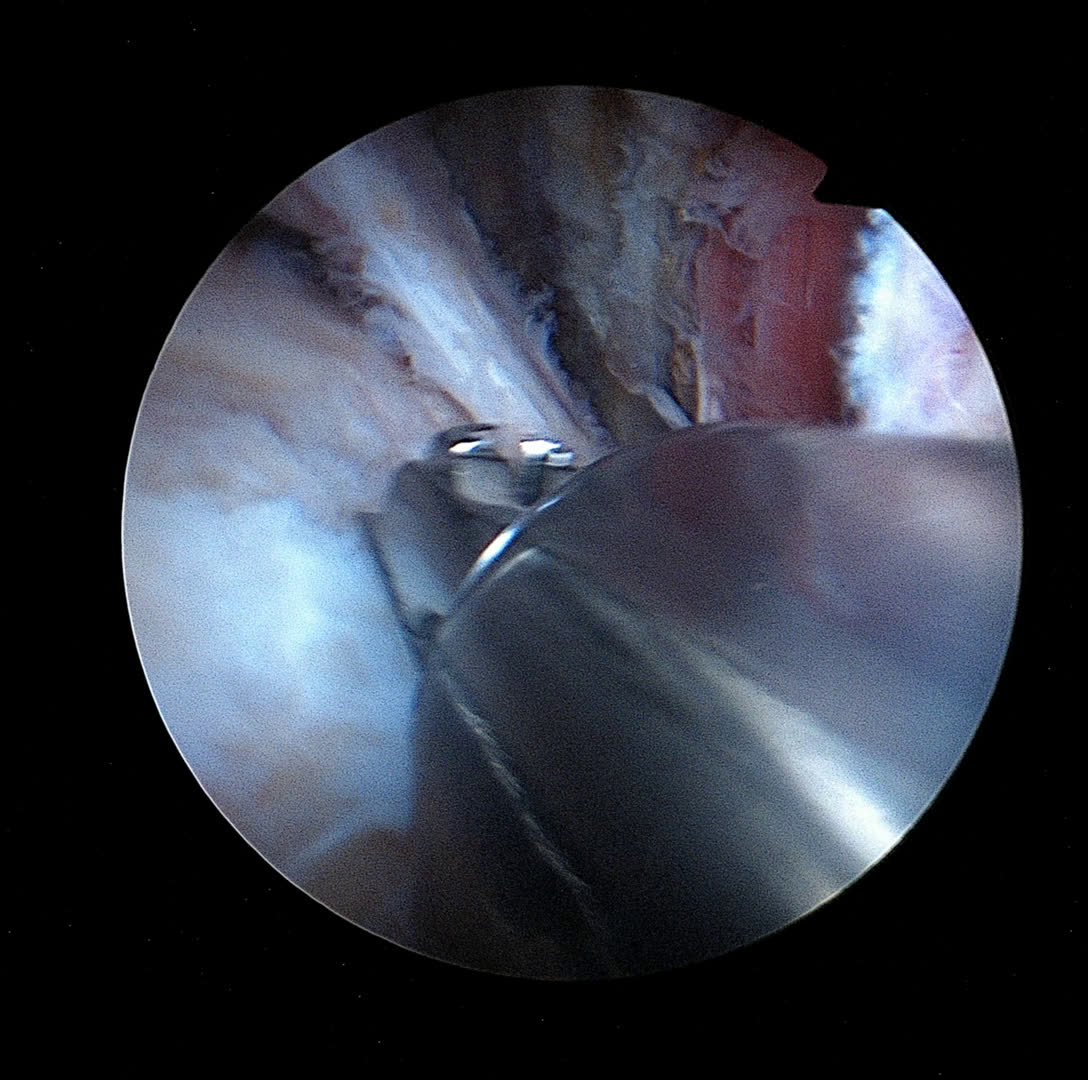 Suture du sous scapulaire proximal - out of the box (Dr Godeneche)