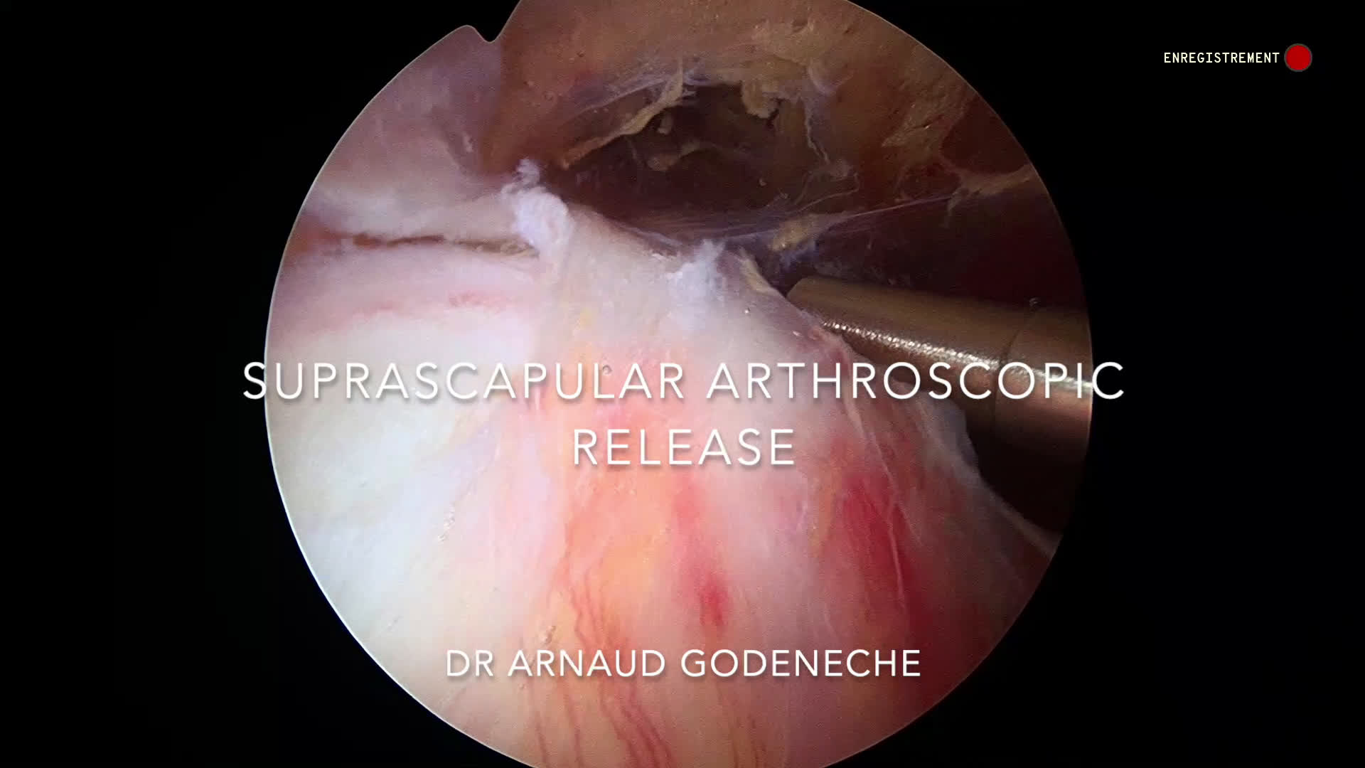 Neurolyse nerf suprascapulaire avec plastie de l'échancrure (Dr Godeneche)