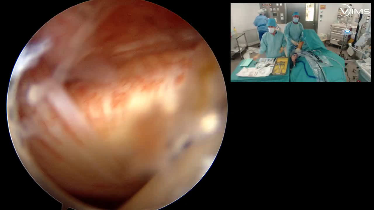 Sus épineux + sus scapulaire avec pince automatique (Dr Gravier)