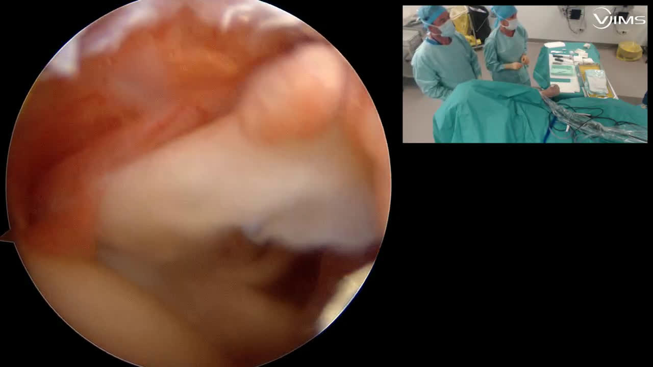 Rupture de coiffe + tenodèse avec pince automatique tips & tricks (trucs et astuces) (Dr Gravier)