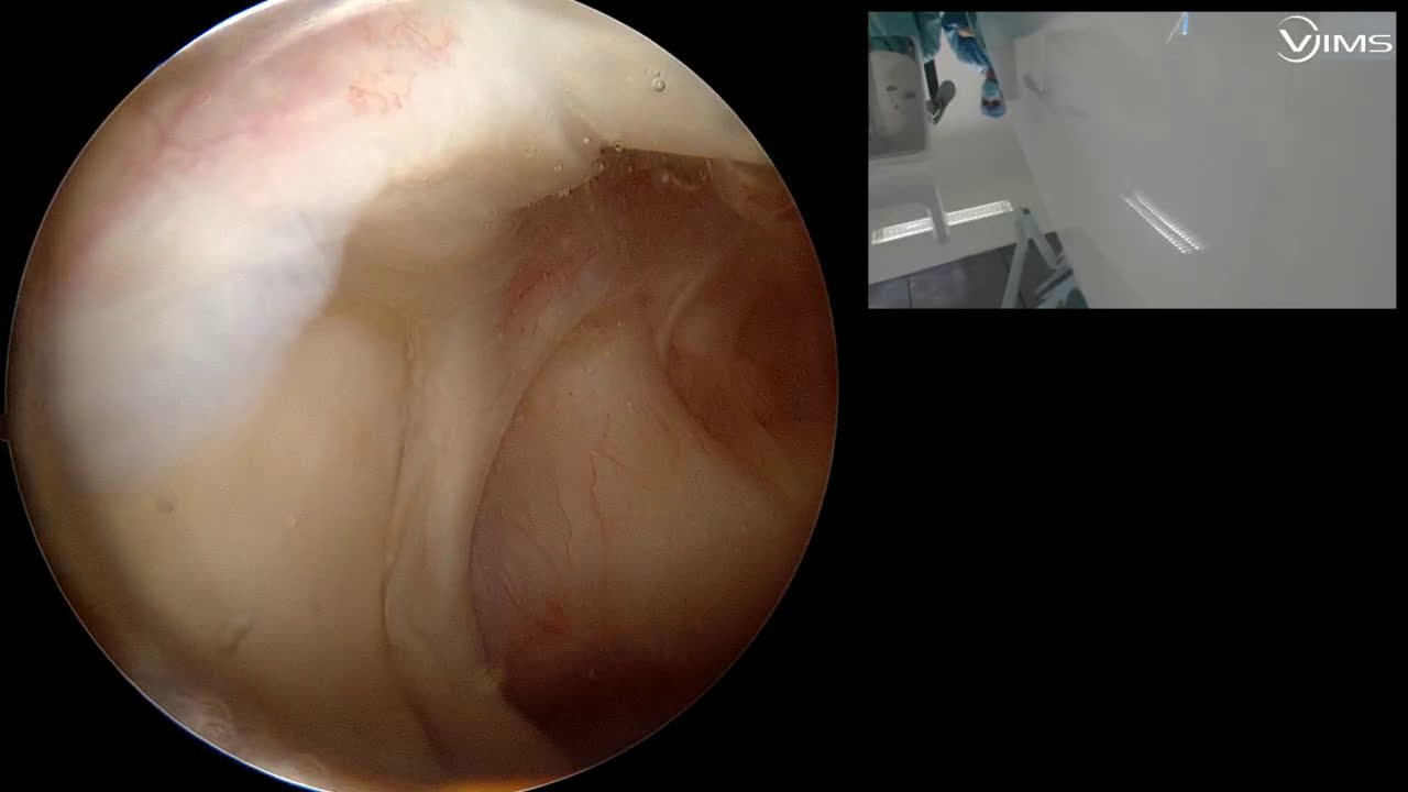 Lésion de la face superficielle du sus-épineux (Dr Gravier)