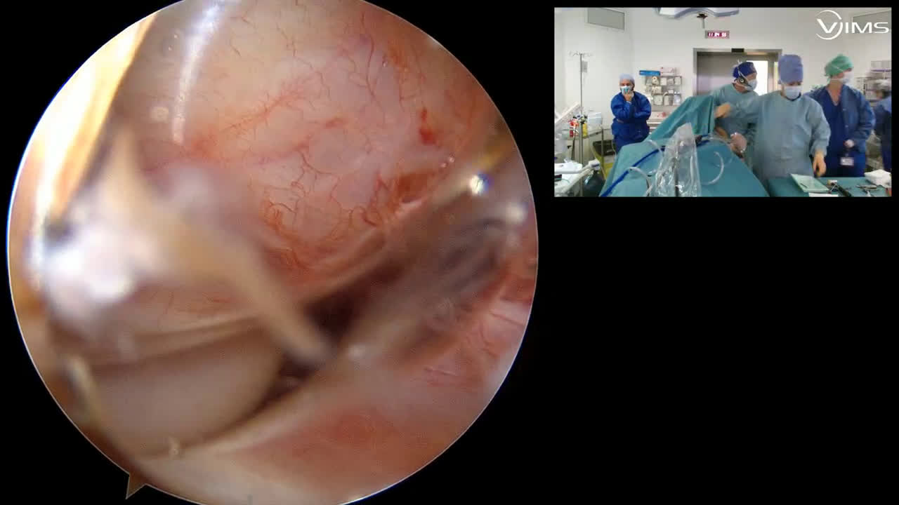 Ténodèse du biceps et réparation lésion sus-epineux (Dr Gravier)