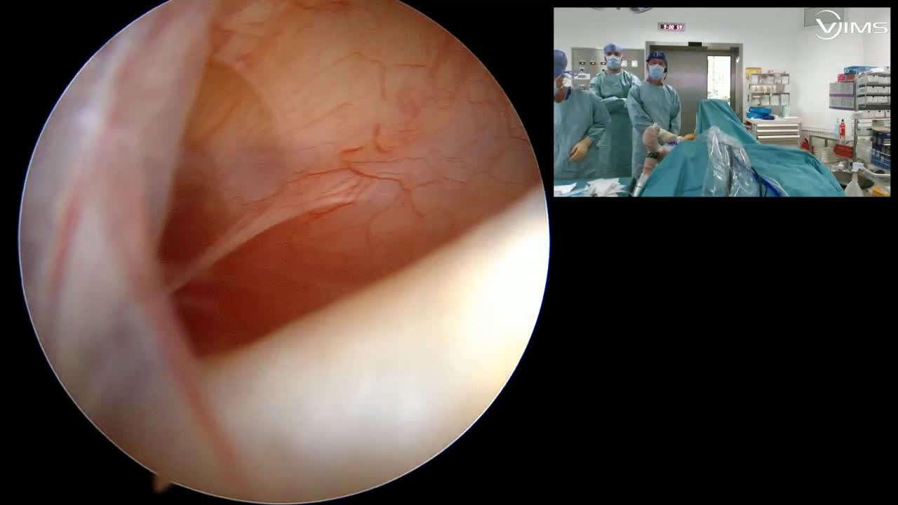 Face superficielle sus épineux non complète (Dr Gravier)
