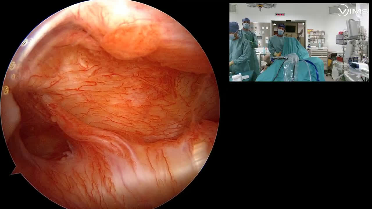 45 ans sus-épineux traumatique + tenodese (Dr Gravier)