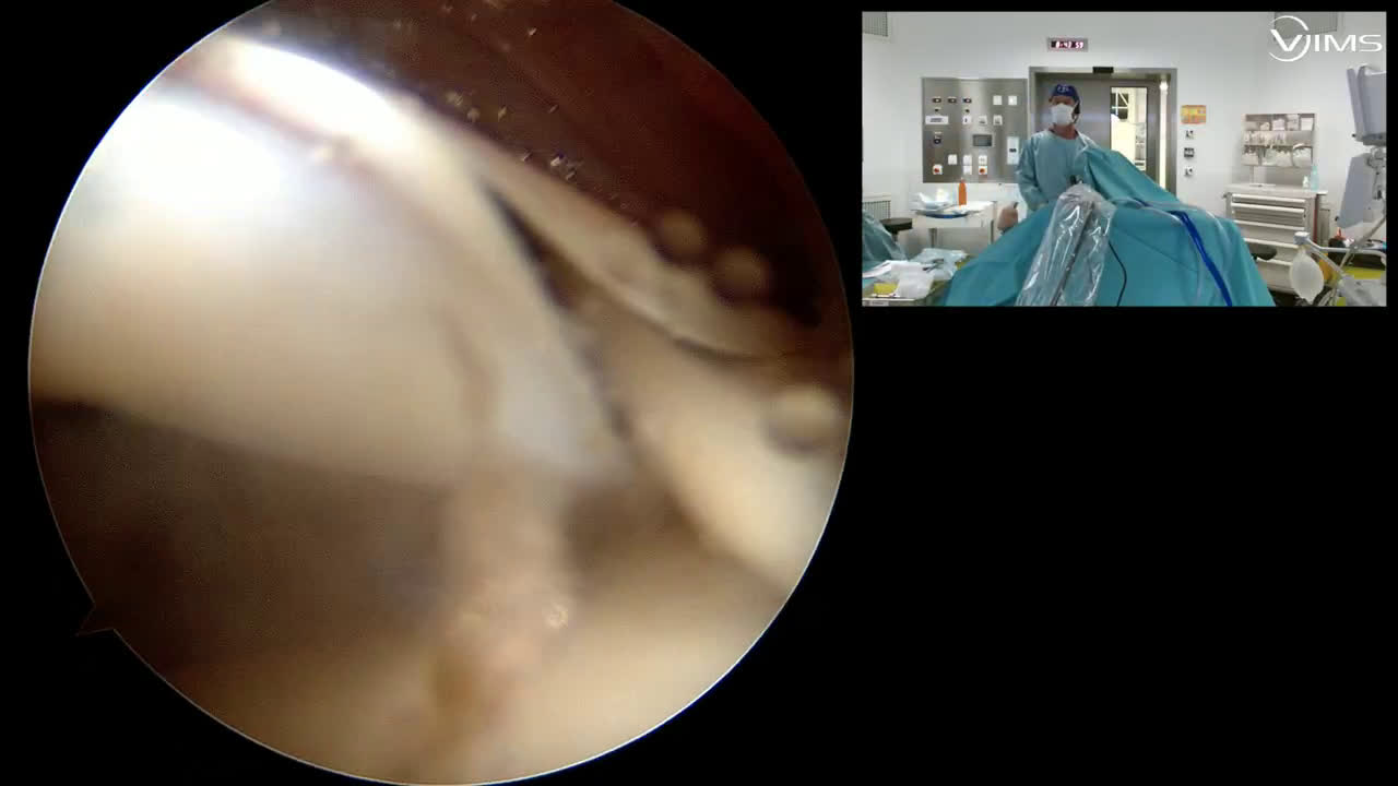 Phase profonde et ténodèse du biceps (Dr Gravier)