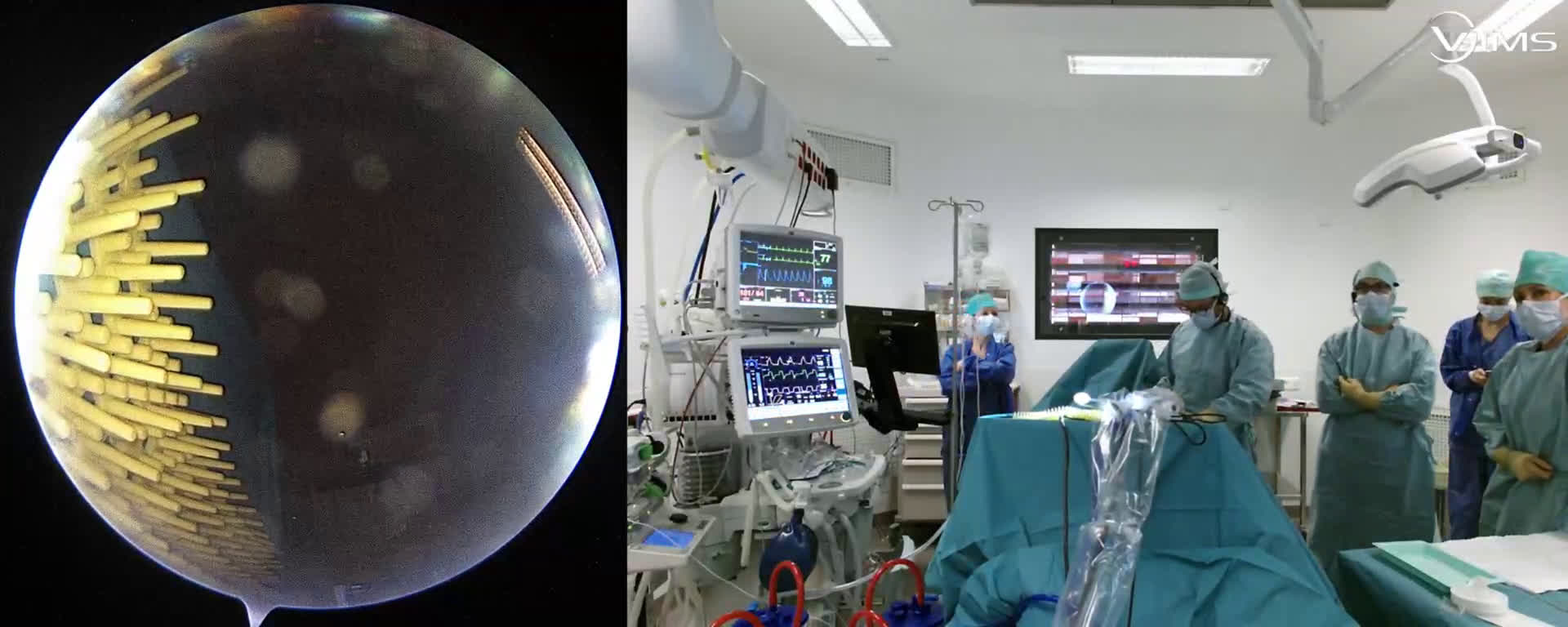 Rupture isolée de la face superficielle du sus-épineux (Dr Gravier)