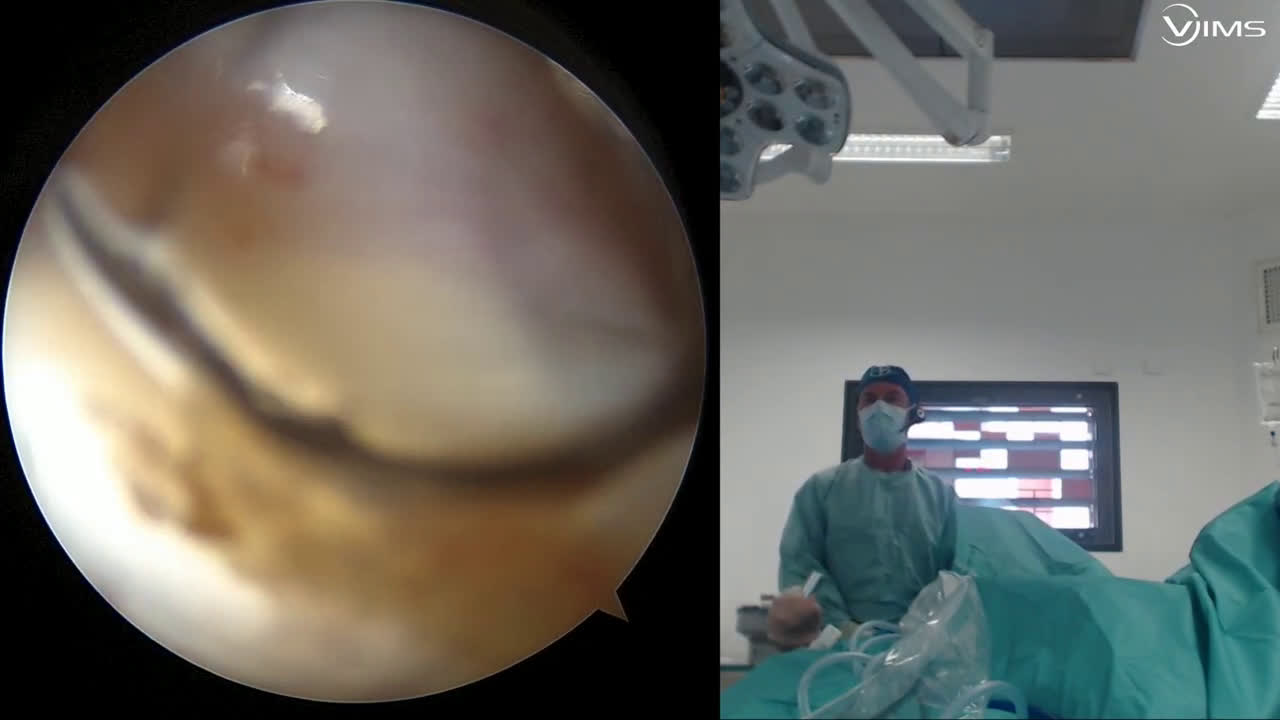 Pince automatique Soft Ligament Anchor (Dr Gravier)