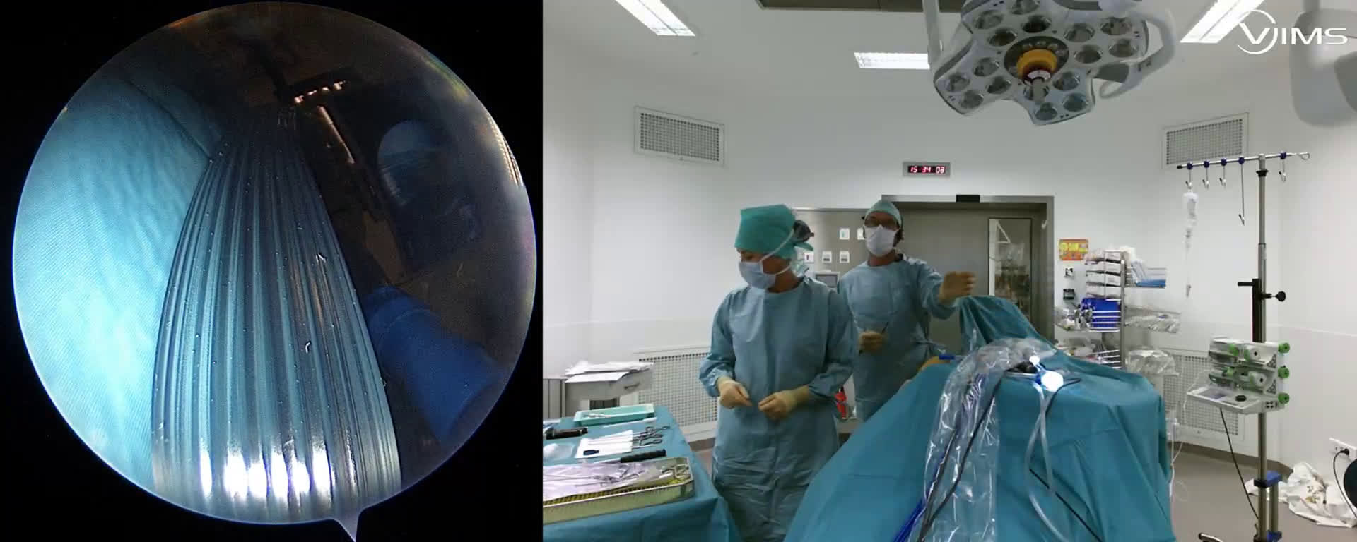 Rupture du sous-scapulaire et du sus-épineux chez un sujet de 48 ans (Dr Gravier)