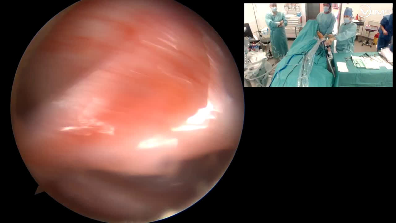 Anterior supra-spinatus tear and posterior biceps instability (Dr Gravier)