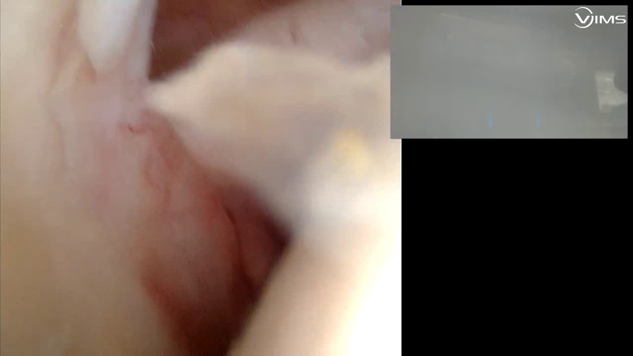 Supraspinatus tear: Mason-Allen stitch (Dr Gravier)