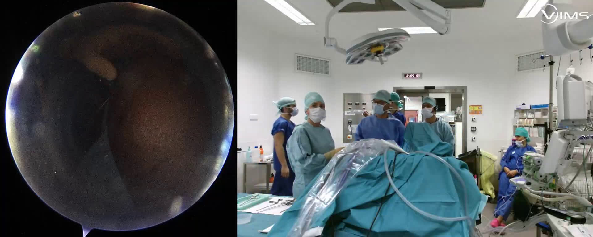 Lésion isolée du sous-scapulaire avec poulie intacte (Dr Gravier)