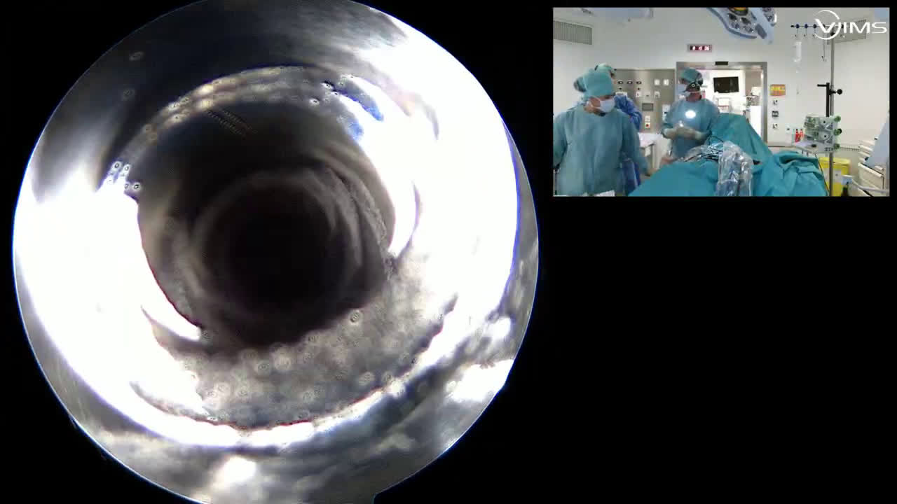 Rupture du sus-épineux & sous-scapulaire + ténodèse biceps - Utilisation de tape (Dr Gravier)