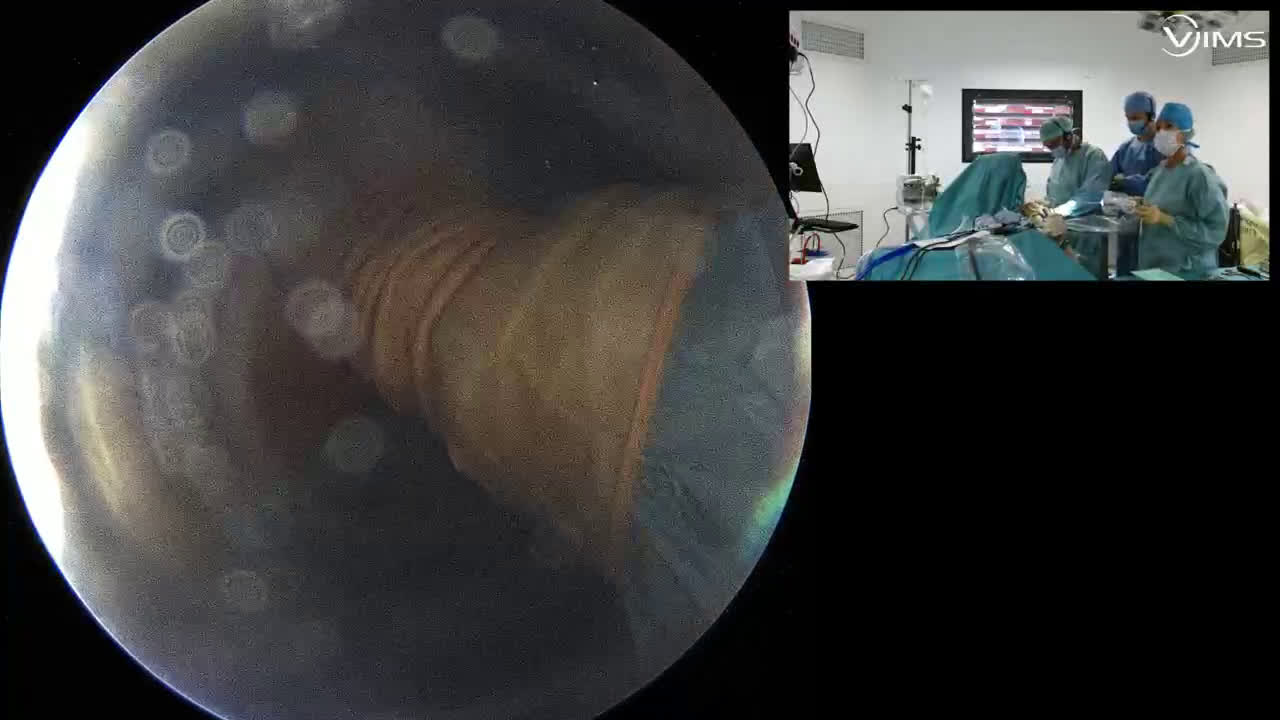 Sous-scapulaire et sus-épineux ténotomie autobloquante du biceps (Dr Gravier)