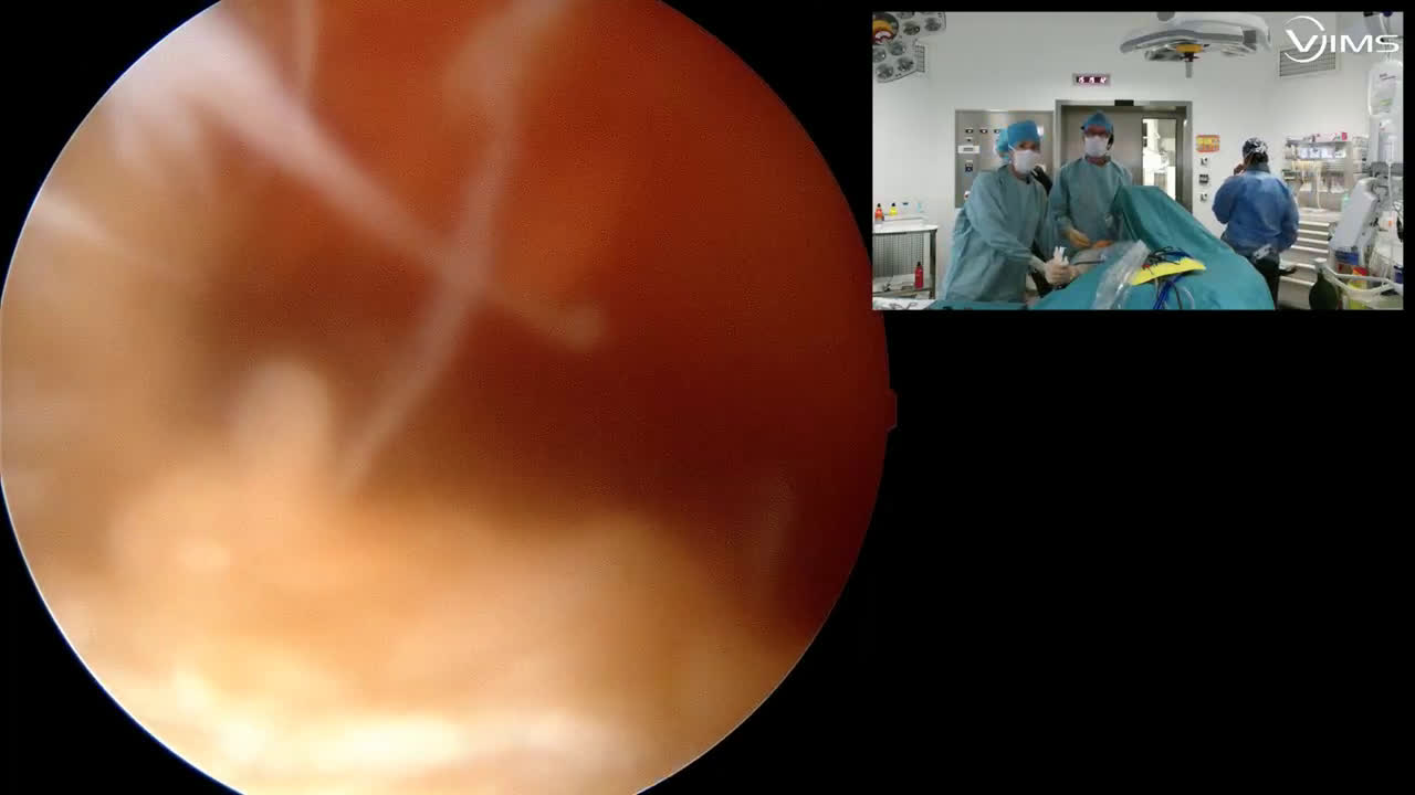 Rupture massive traumatique de la coiffe des rotateurs sous-scapulaire sus-épineux / sous-épineux (Dr Gravier)