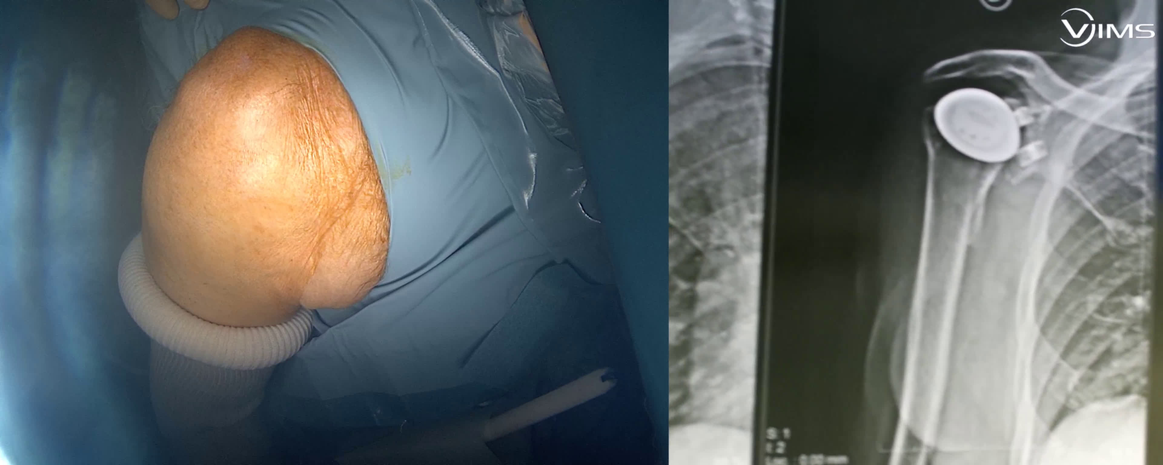 Changement prothétique : une prothèse anatomique à une prothèse inversée (Dr Gravier)