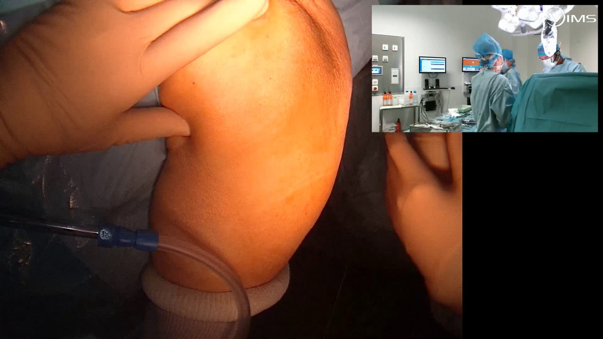 Implant inversé Tornier asend flex (Dr Gravier)