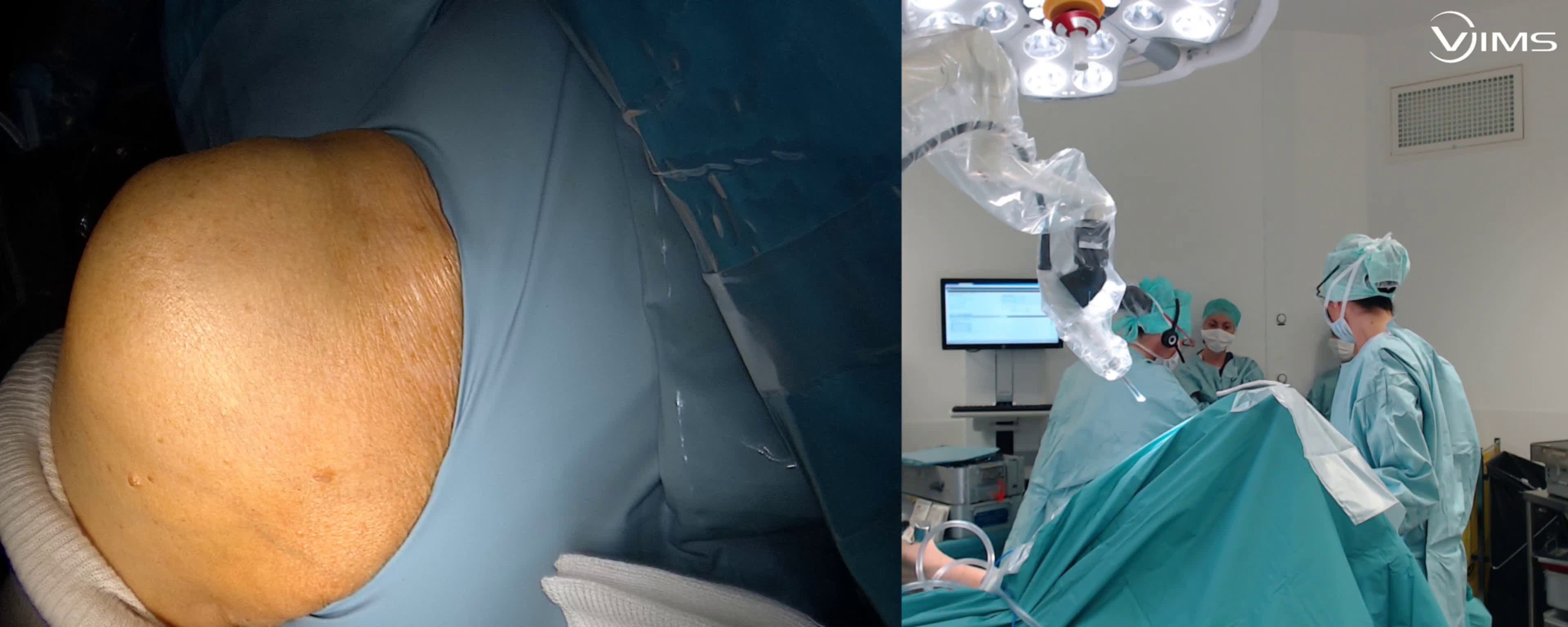 Prothèse inversée avec greffe intercalaire (Dr Gravier)