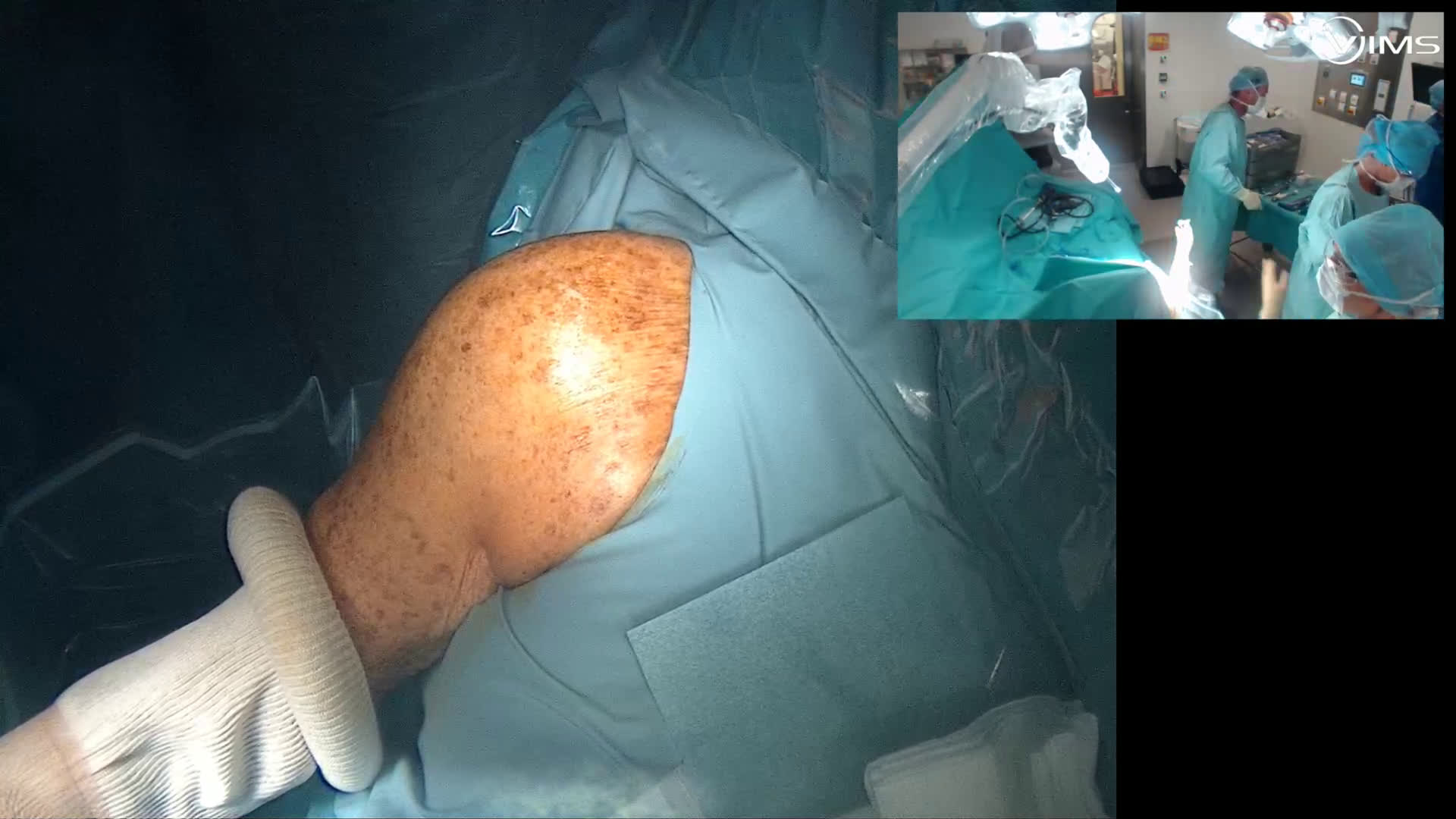 Implant inversé sur séquelle de fracture (Dr Gravier)